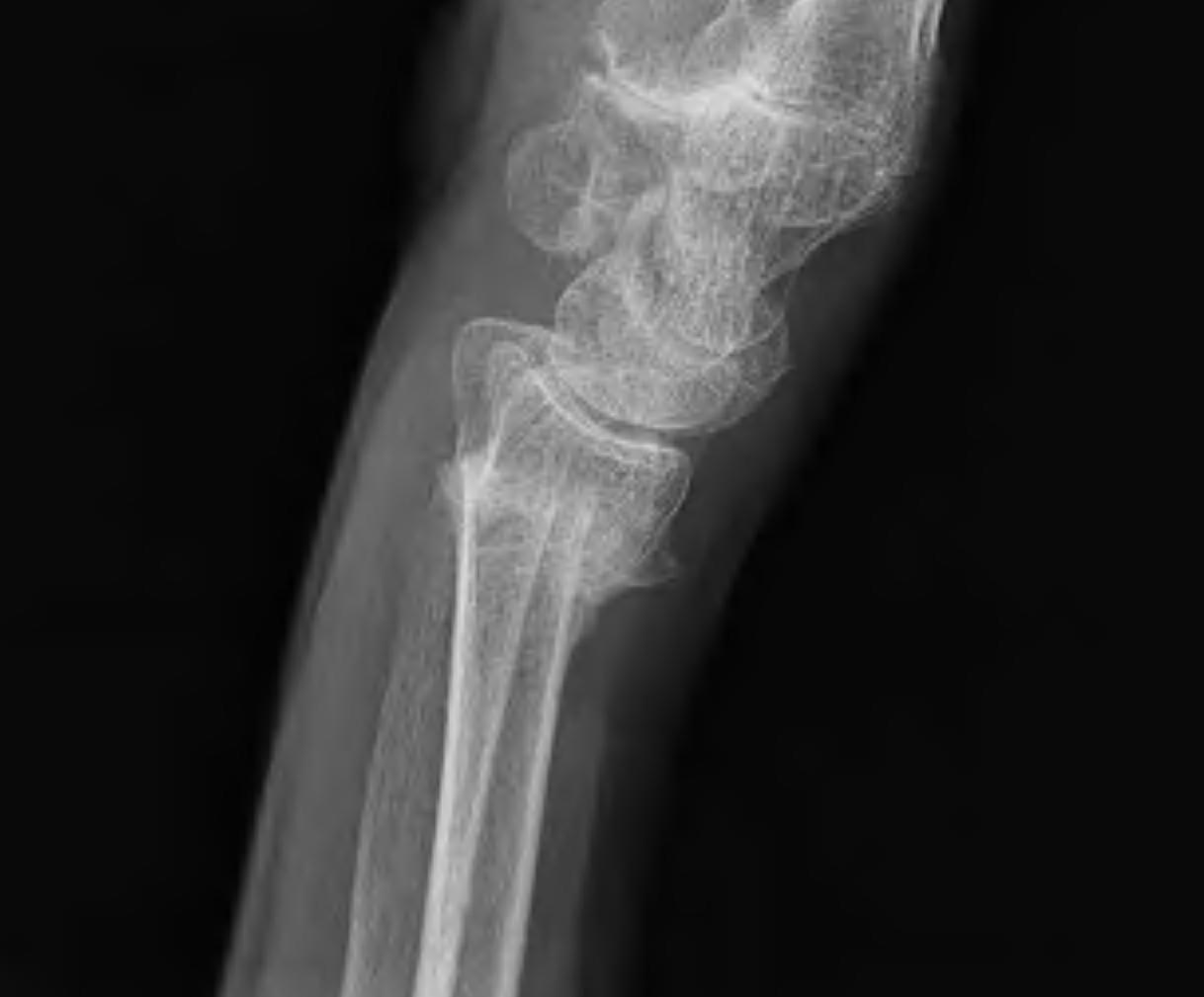 Distal Radial Malunion Dorsal Tilt